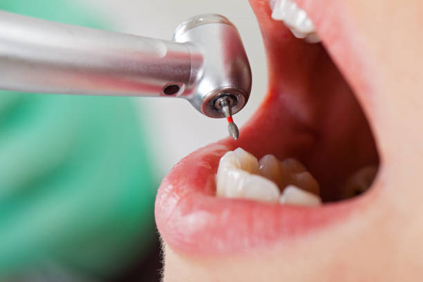 Best Emergency Wisdom Tooth Extraction in Winslow, AZ